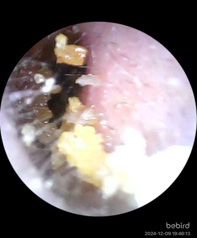 Close-up view of earwax and debris in an ear canal.