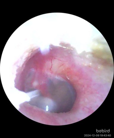 Close-up view of a human ear canal with visible moisture and tissues.