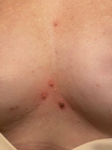 Close-up of a person's chest with several small red spots and blemishes.